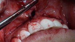 perio esthetic surgery Esthetic crown lengthening_15