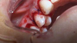 perio esthetic surgery Esthetic crown lengthening_17