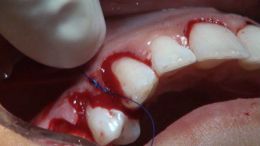 perio esthetic surgery Esthetic crown lengthening_18