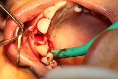 18 th International congress of Iranian association of oral and maxillofacial surgeons_21