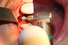 18 th International congress of Iranian association of oral and maxillofacial surgeons_24