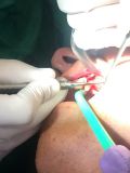 Sinus graft course with live surgey