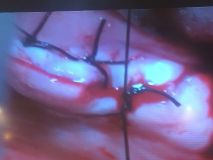 Sinus graft course with live surgey