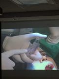 SPI system presentation with live surgery
