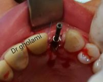 SPI system presentation with live surgery_21