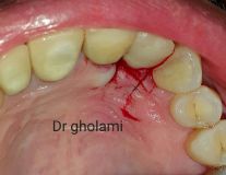 SPI system presentation with live surgery_24