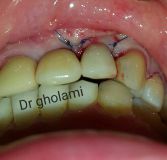 SPI system presentation with live surgery_26